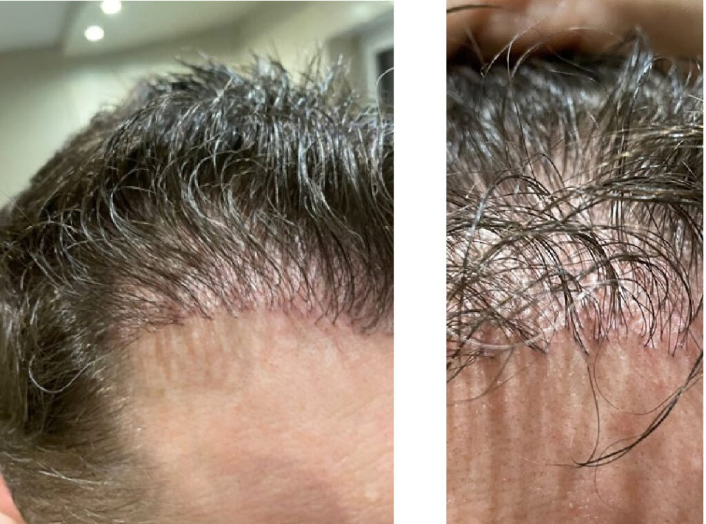 1 anno dopo il trapianto di capelli turchia