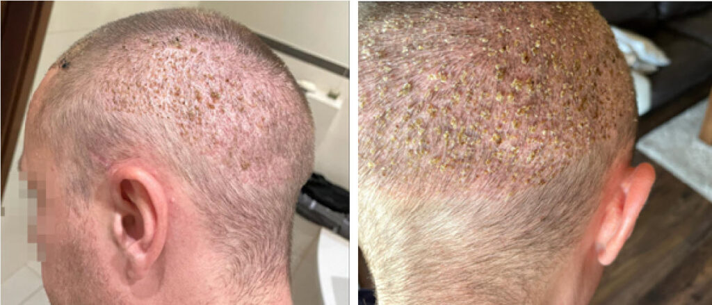 3 settimane dopo l'intervento di trapianto di capelli