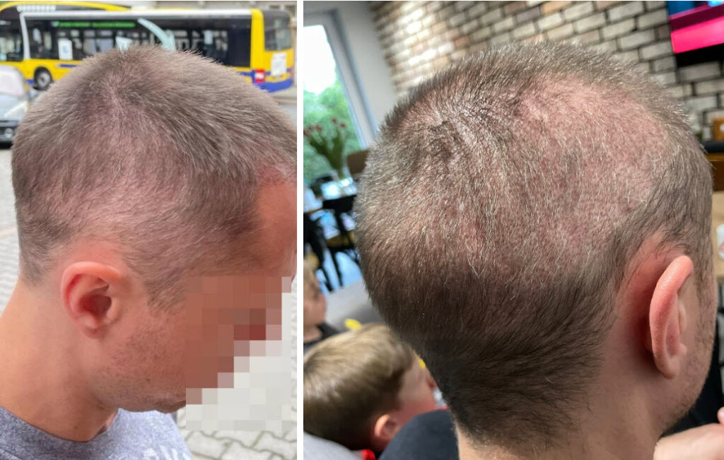 5 mesi dopo il trapianto di capelli capelli sovrasfruttati
