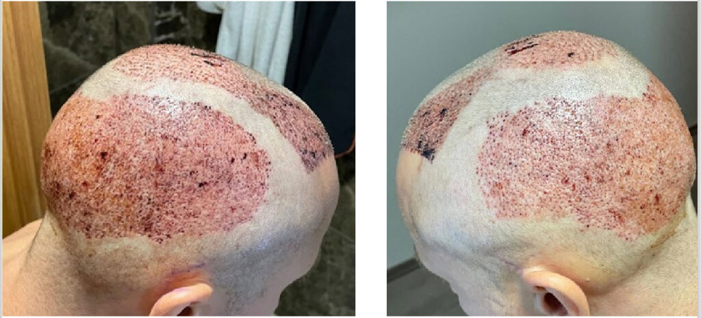 dopo il trapianto di capelli turchia