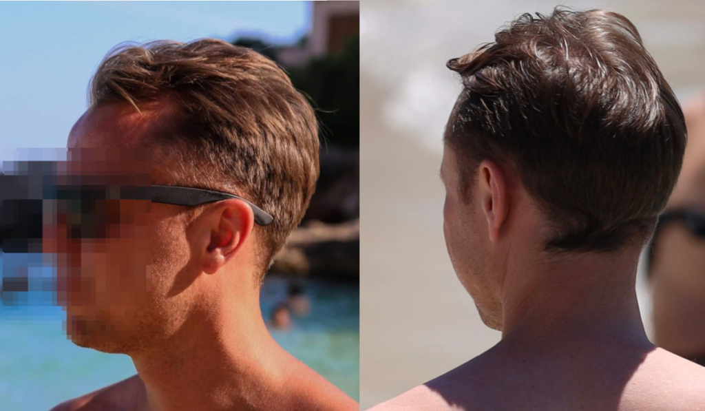 prima del trapianto di capelli