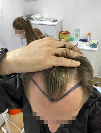 prima del trapianto di capelli clinica illegale