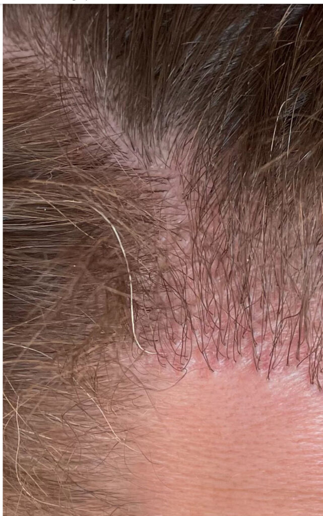 risultati del trapianto di capelli 1 anno mercato nero