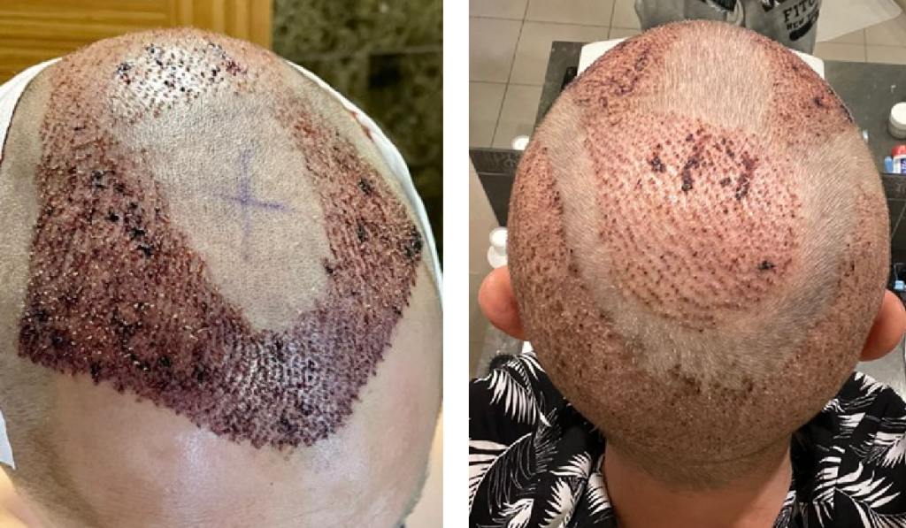 una settimana dopo l'intervento di trapianto di capelli turchia