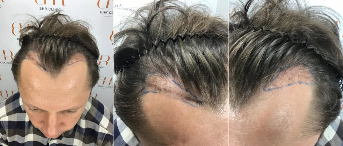 14 mesi dopo la riparazione del trapianto di capelli