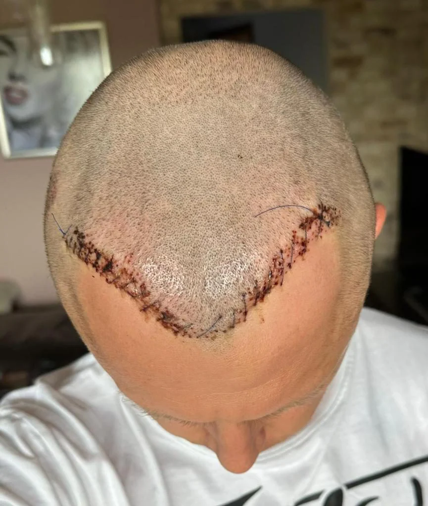 dopo la riparazione del trapianto di capelli