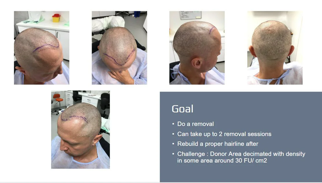 riparazione del trapianto di capelli