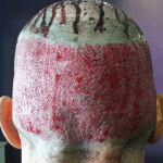 Scalped Man